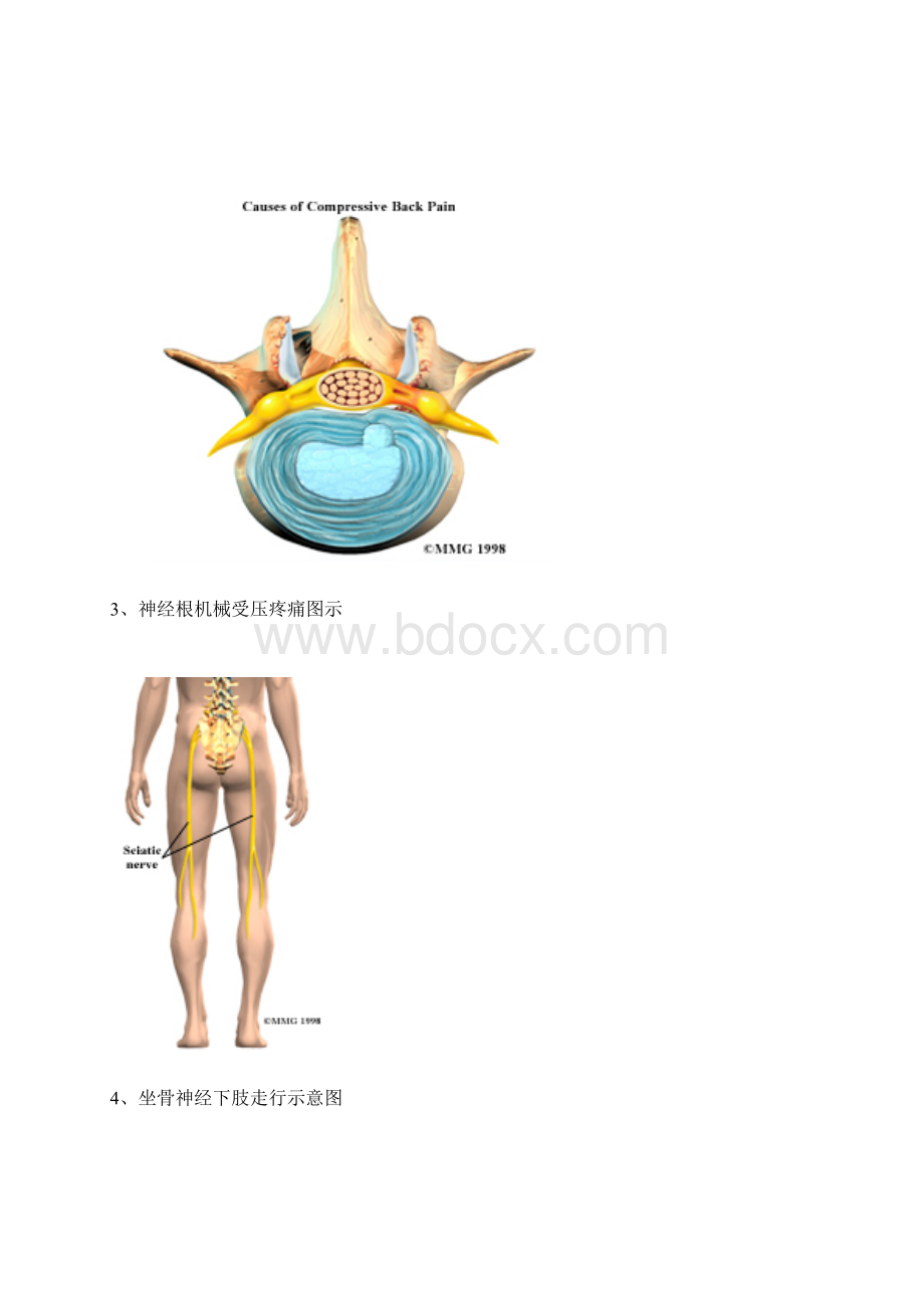 腰椎病腰间盘突出解剖图.docx_第2页