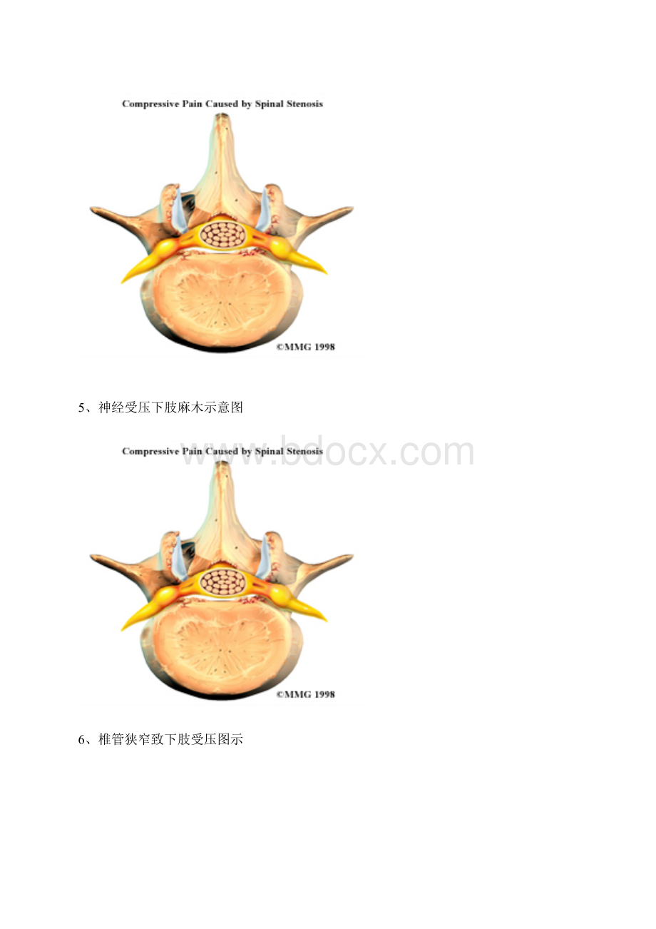 腰椎病腰间盘突出解剖图.docx_第3页