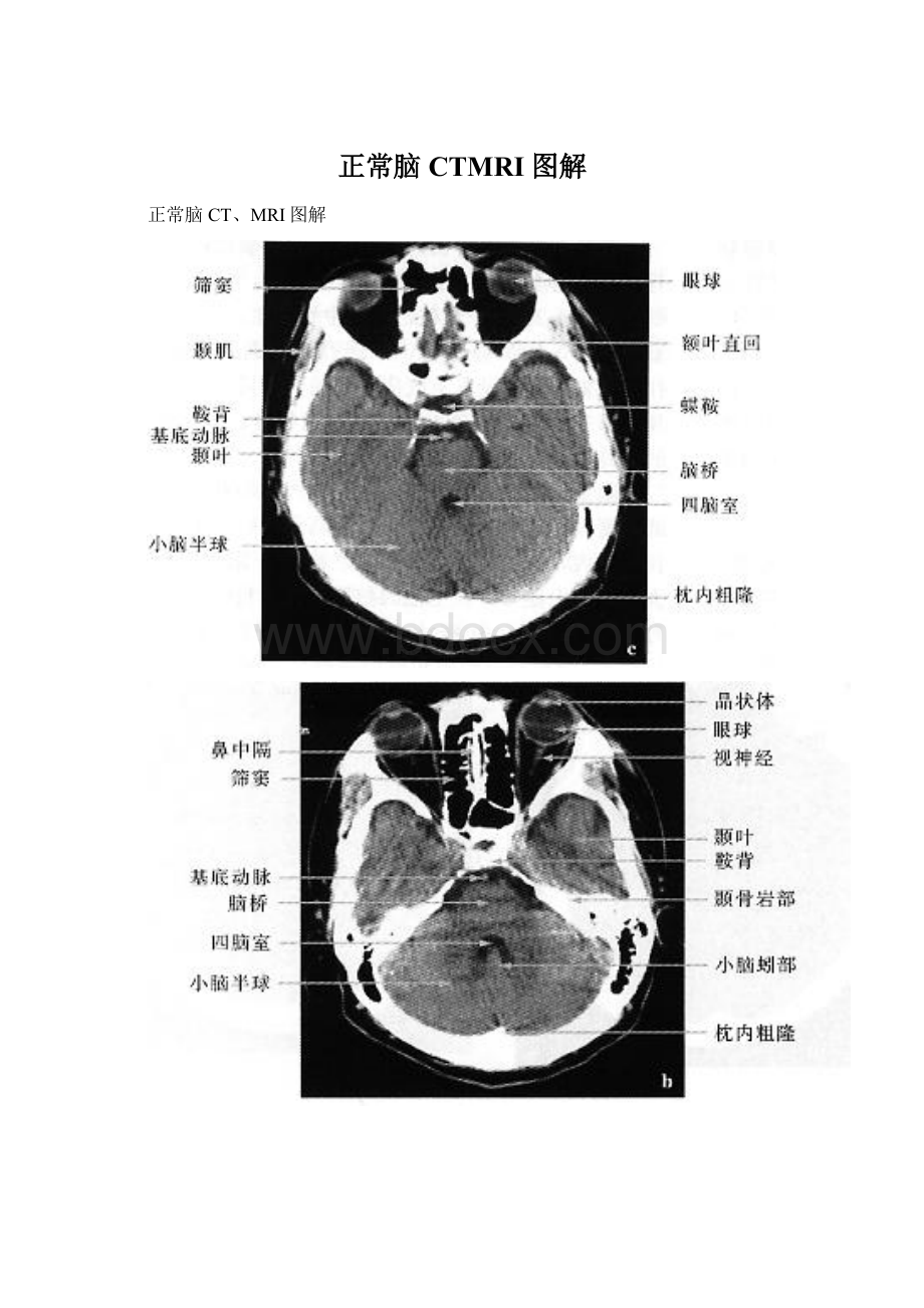 正常脑CTMRI图解.docx_第1页