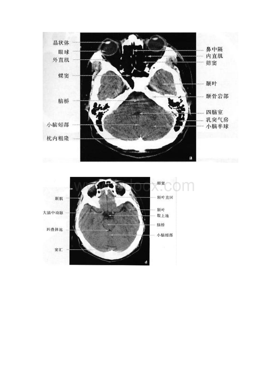 正常脑CTMRI图解.docx_第2页