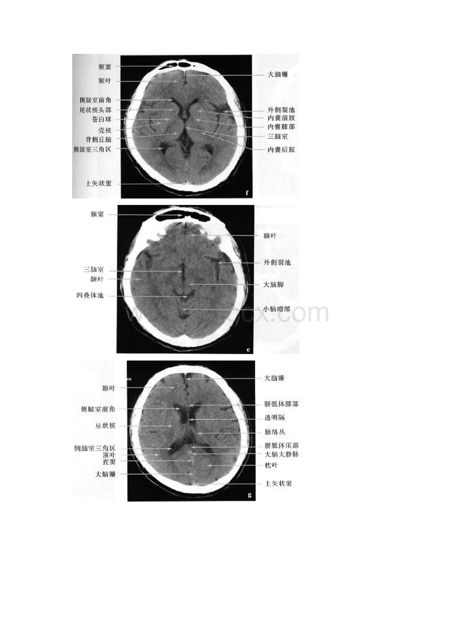 正常脑CTMRI图解.docx_第3页