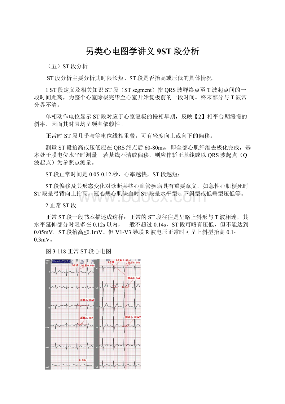 另类心电图学讲义9ST段分析.docx