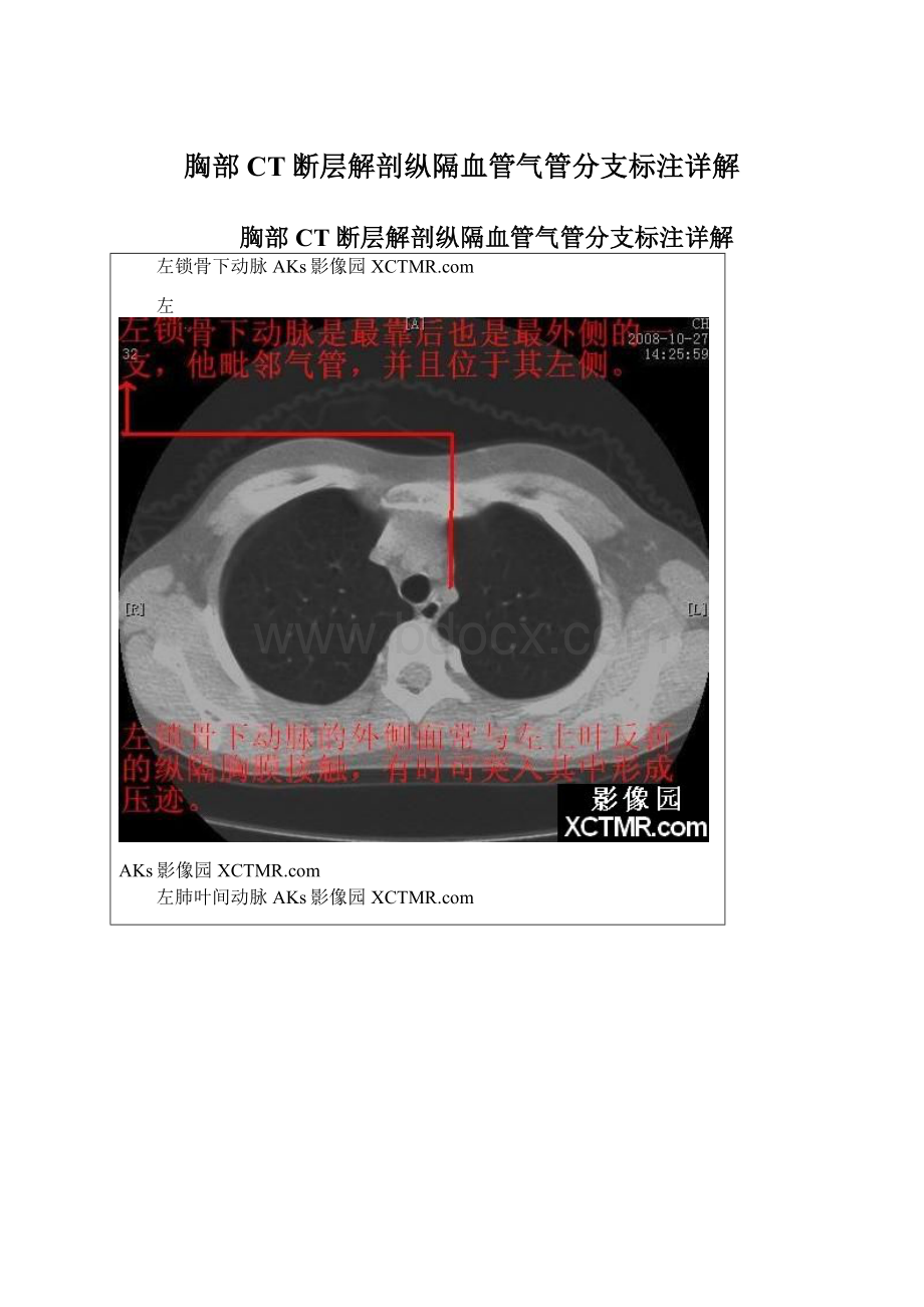 胸部CT断层解剖纵隔血管气管分支标注详解.docx