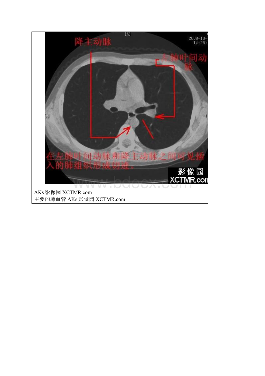 胸部CT断层解剖纵隔血管气管分支标注详解.docx_第2页