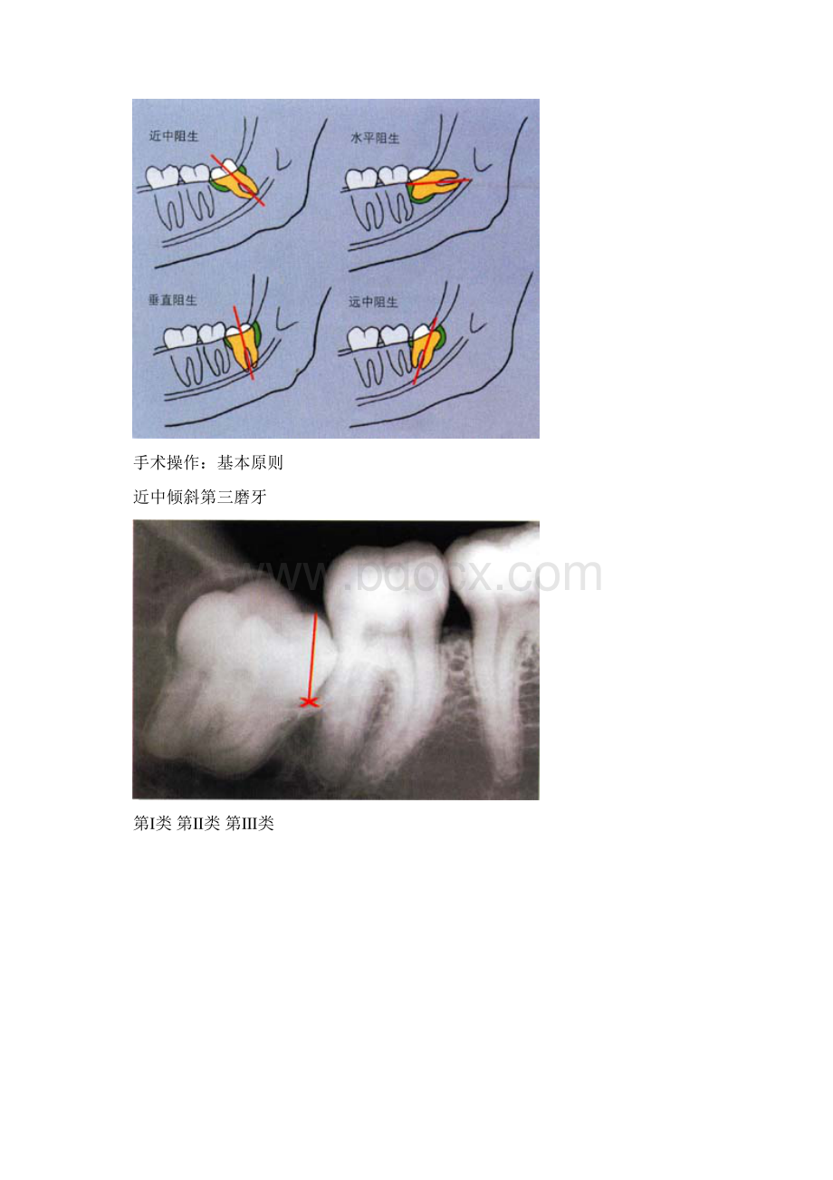 拔牙技巧图解.docx_第2页