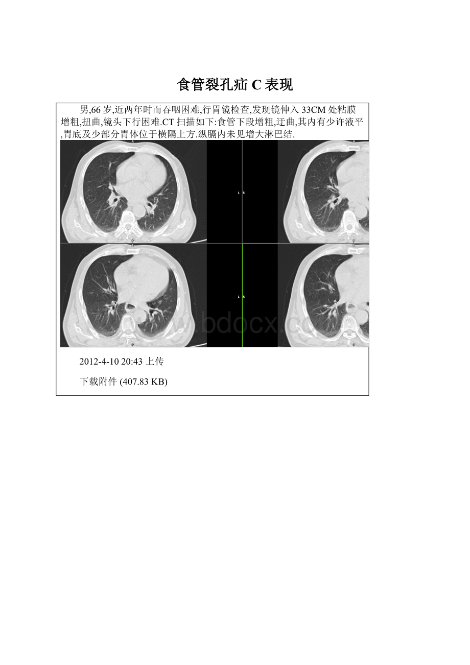 食管裂孔疝C表现Word格式文档下载.docx