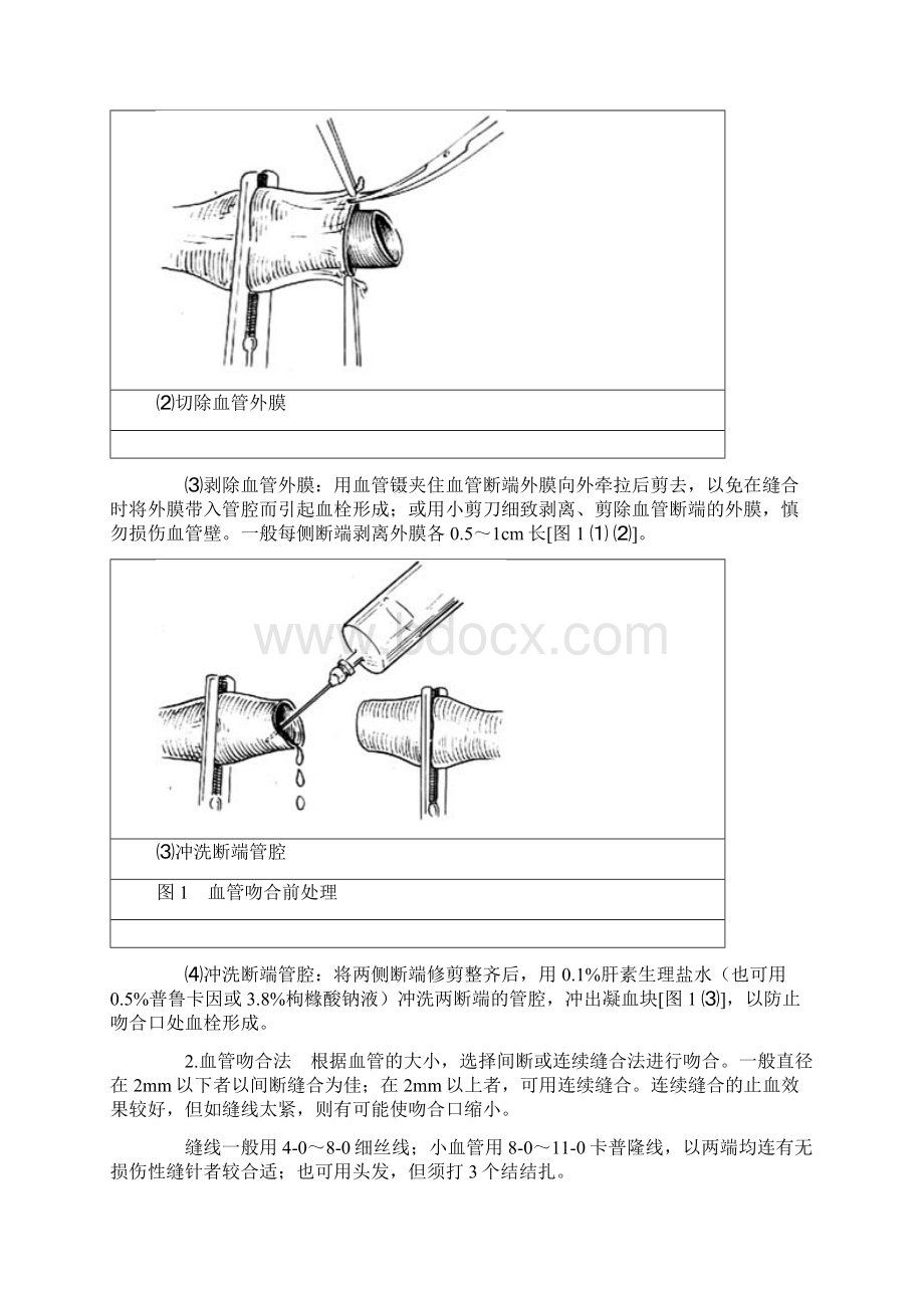 血管端端吻合Word下载.docx_第2页