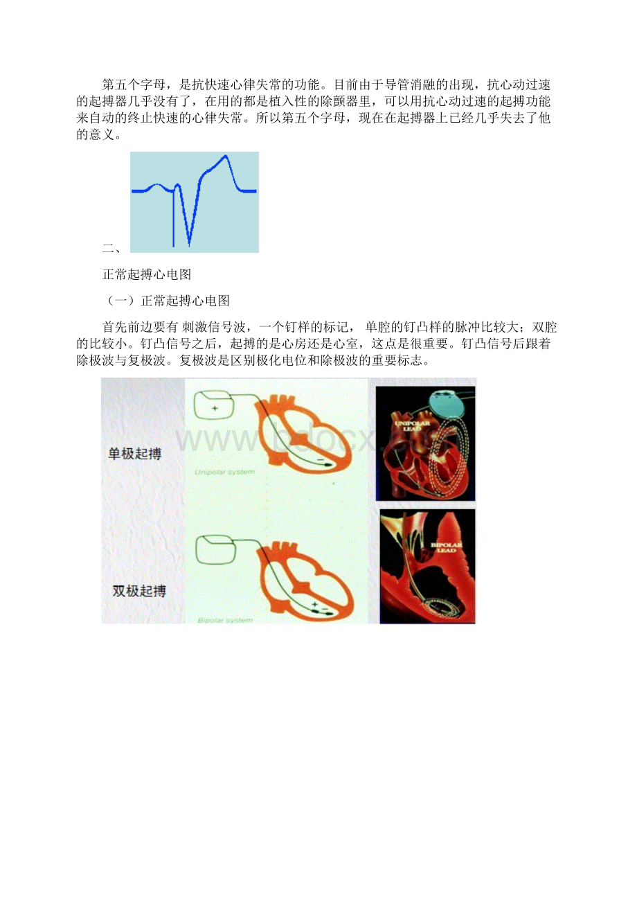 起搏器心电图判读.docx_第2页