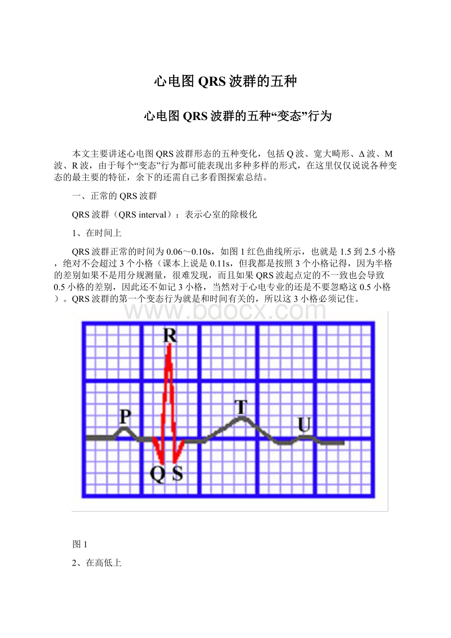 心电图QRS波群的五种.docx