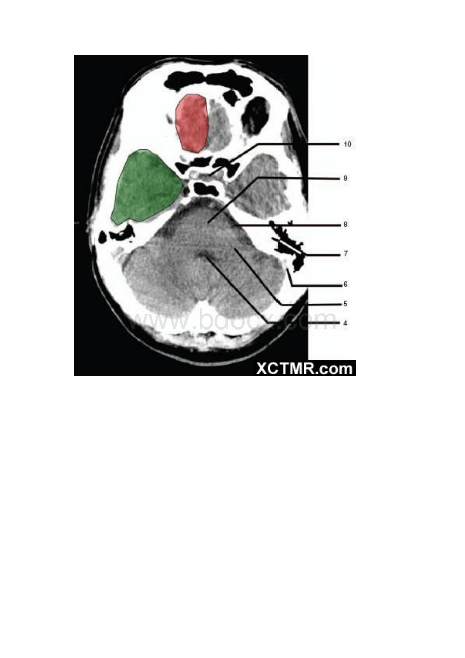 颅脑CT图像.docx_第2页