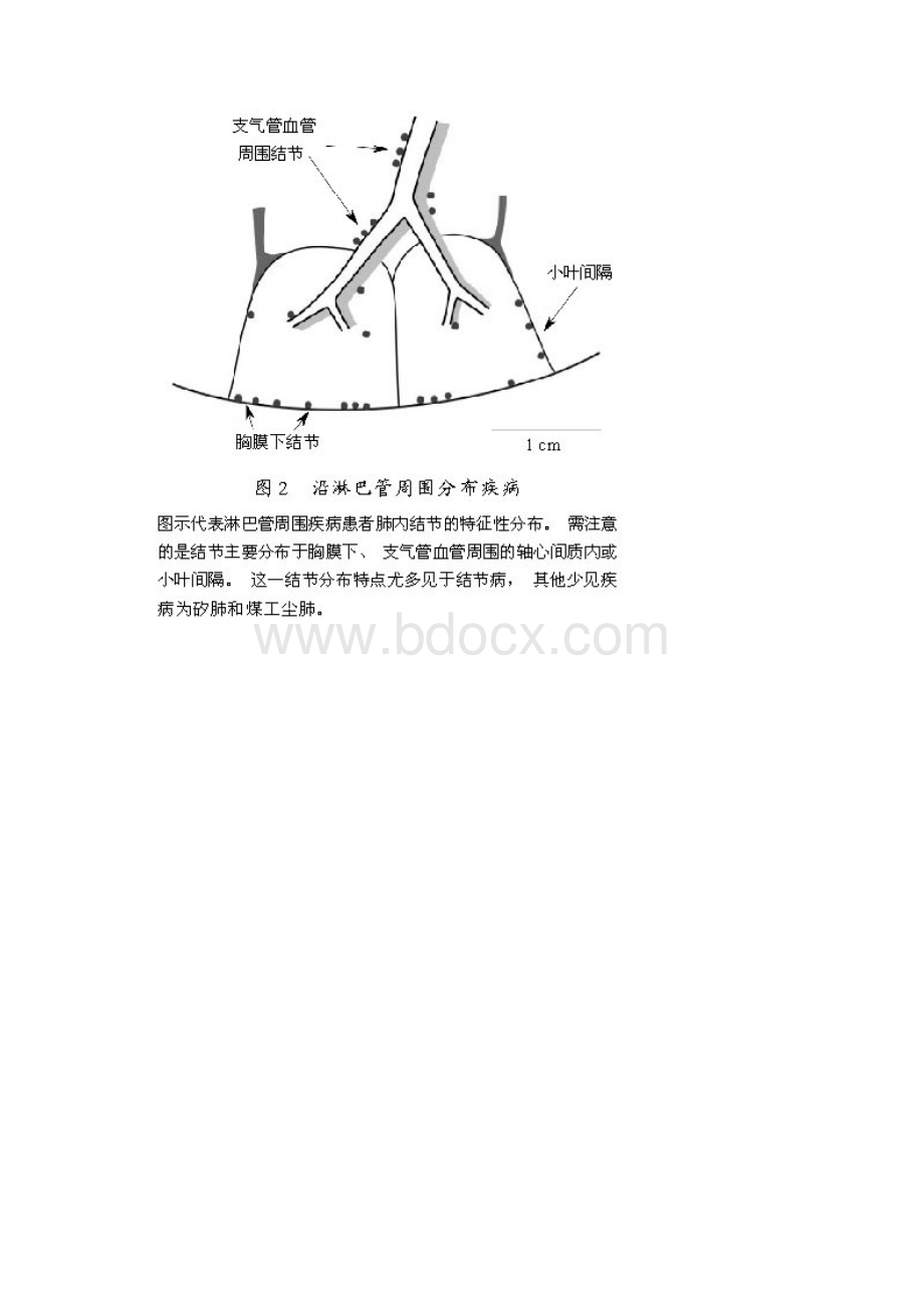 肺内多发结节的高分辨率CT鉴别诊断流程.docx_第3页