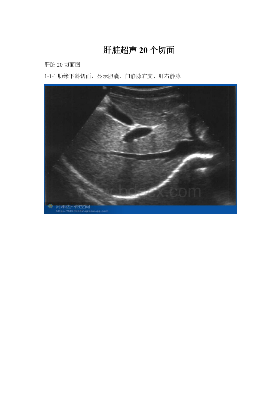 肝脏超声20个切面Word格式文档下载.docx_第1页