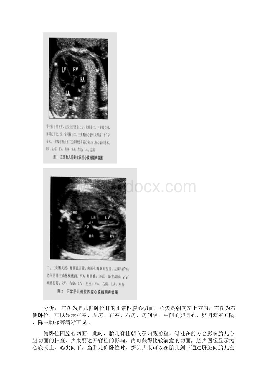 胎儿心脏.docx_第2页