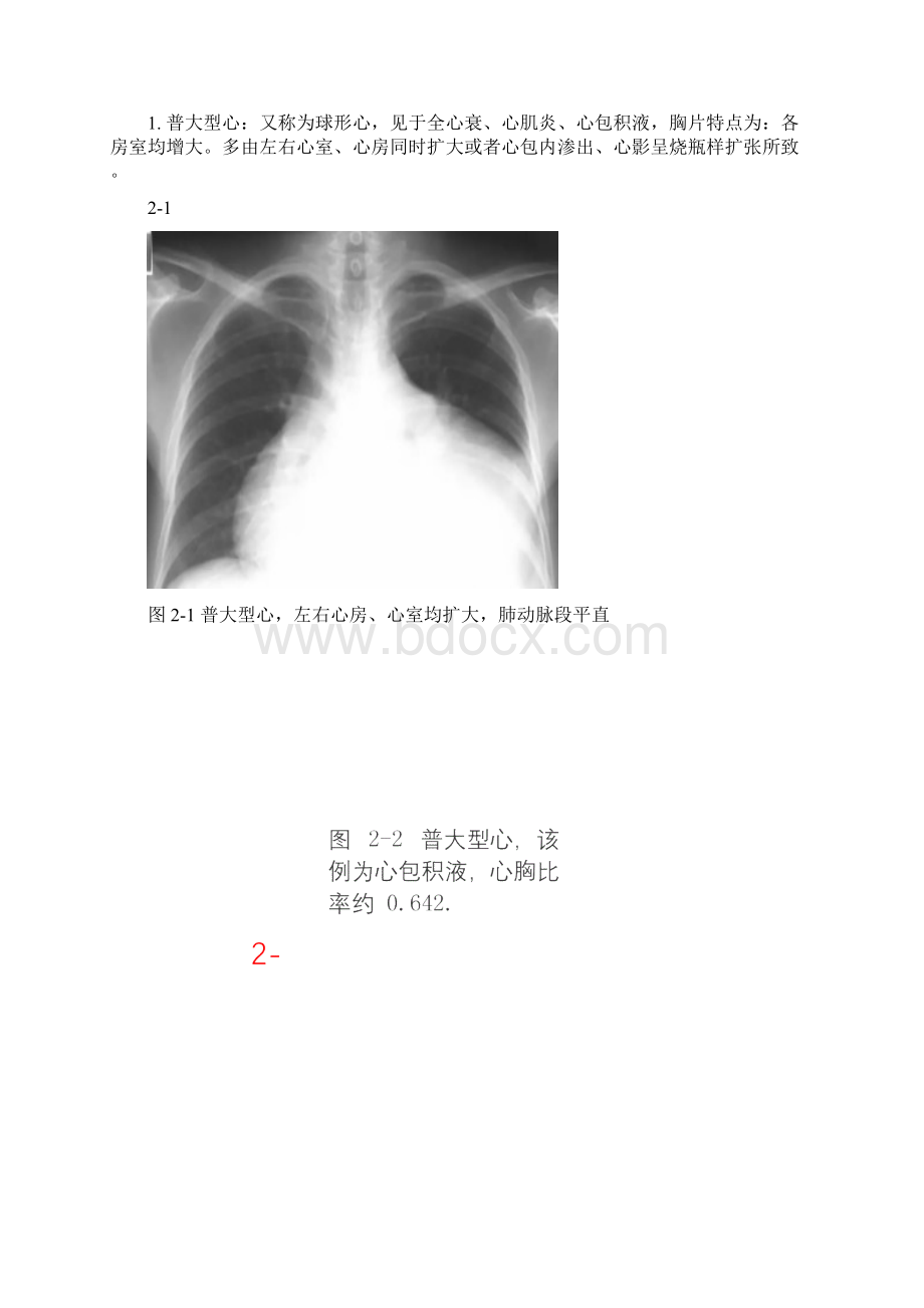 常见的X线胸片.docx_第2页