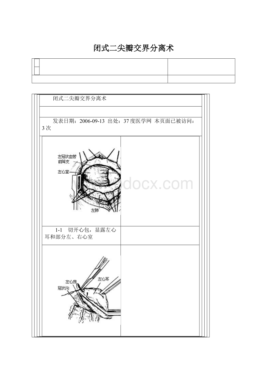 闭式二尖瓣交界分离术Word文档下载推荐.docx