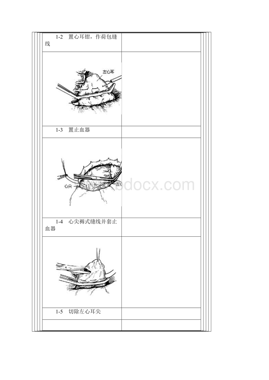 闭式二尖瓣交界分离术Word文档下载推荐.docx_第2页