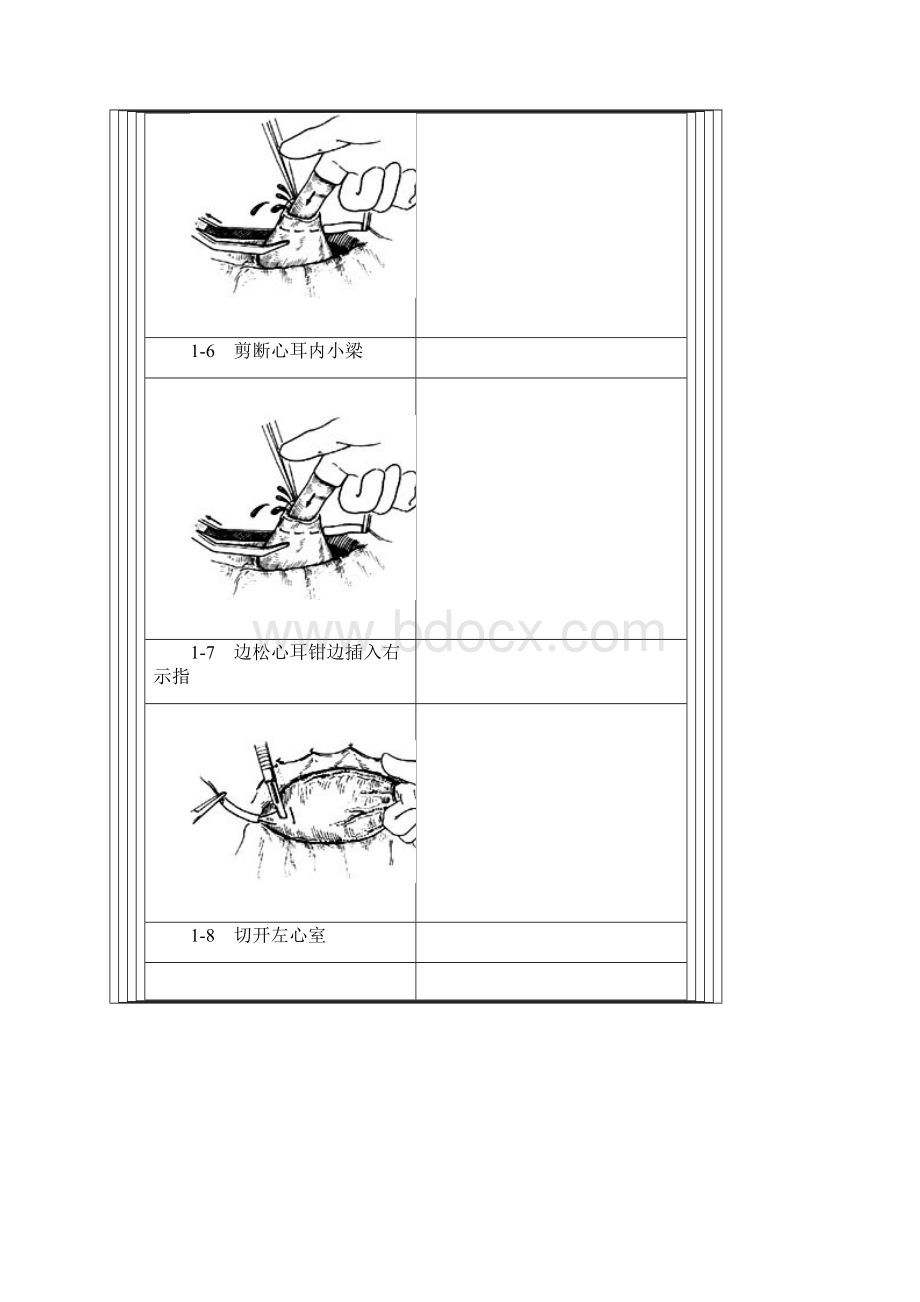 闭式二尖瓣交界分离术Word文档下载推荐.docx_第3页