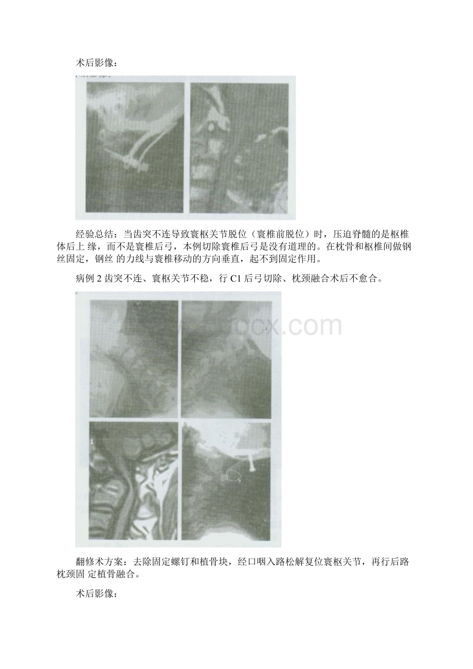 上颈椎翻修术.docx_第3页