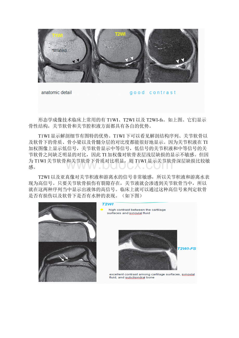 MRI对膝关节软骨损伤的诊断.docx_第3页