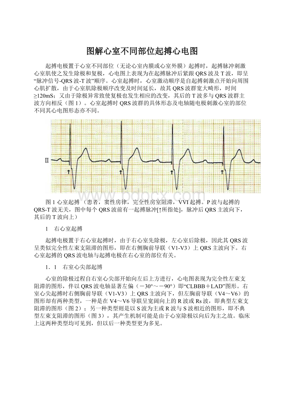 图解心室不同部位起搏心电图.docx