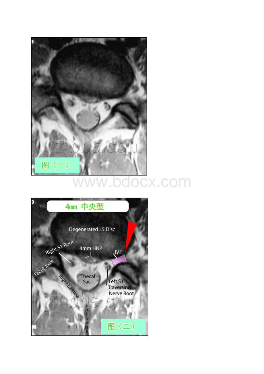 学会看腰椎间盘突出CT和MRI磁共振片子的超好教程.docx_第3页