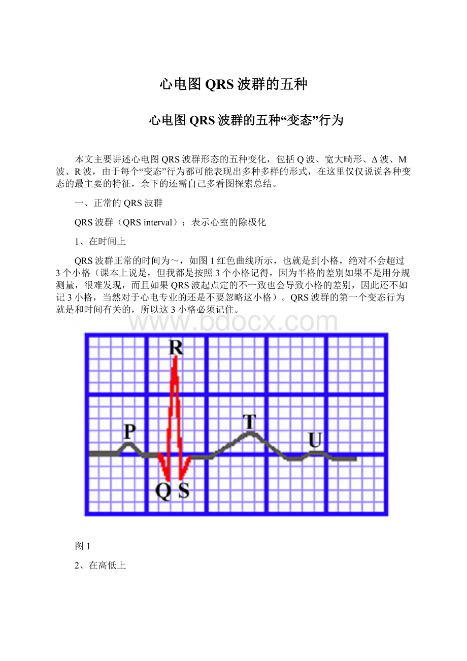 心电图QRS波群的五种.docx