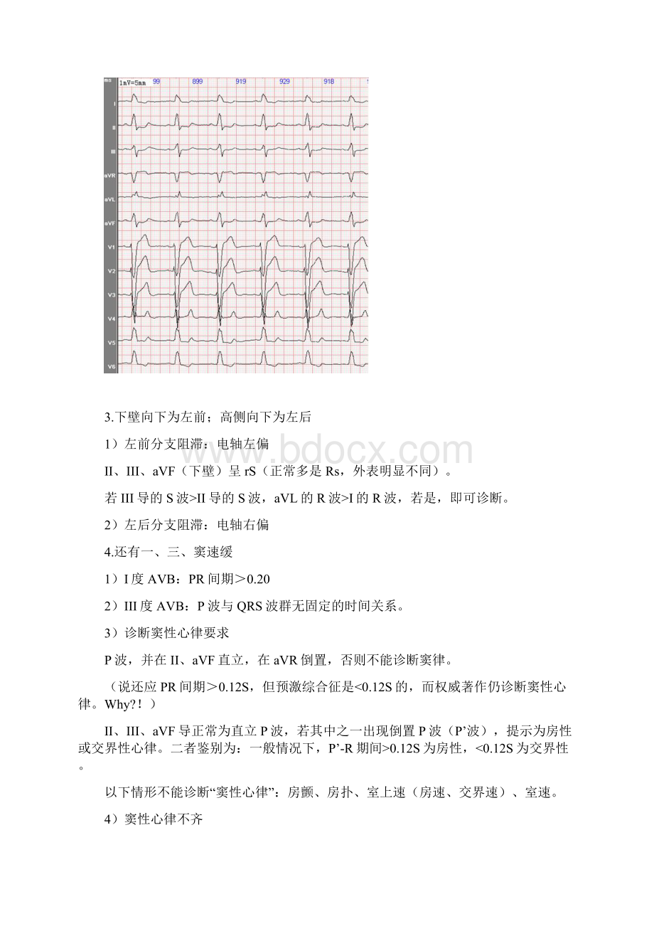 郭雅卿老师心电图口诀Word下载.docx_第3页