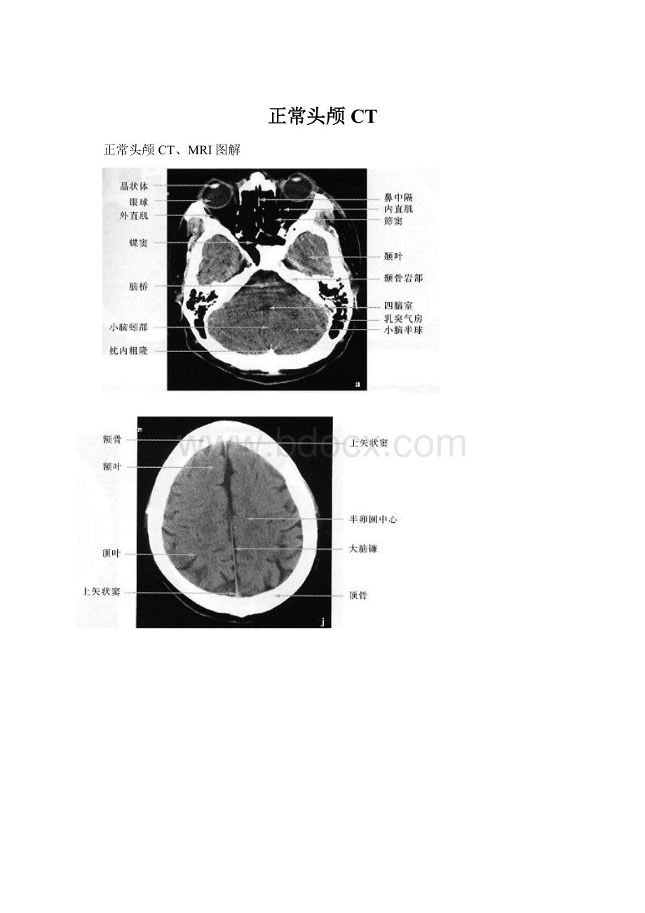 正常头颅CTWord下载.docx_第1页