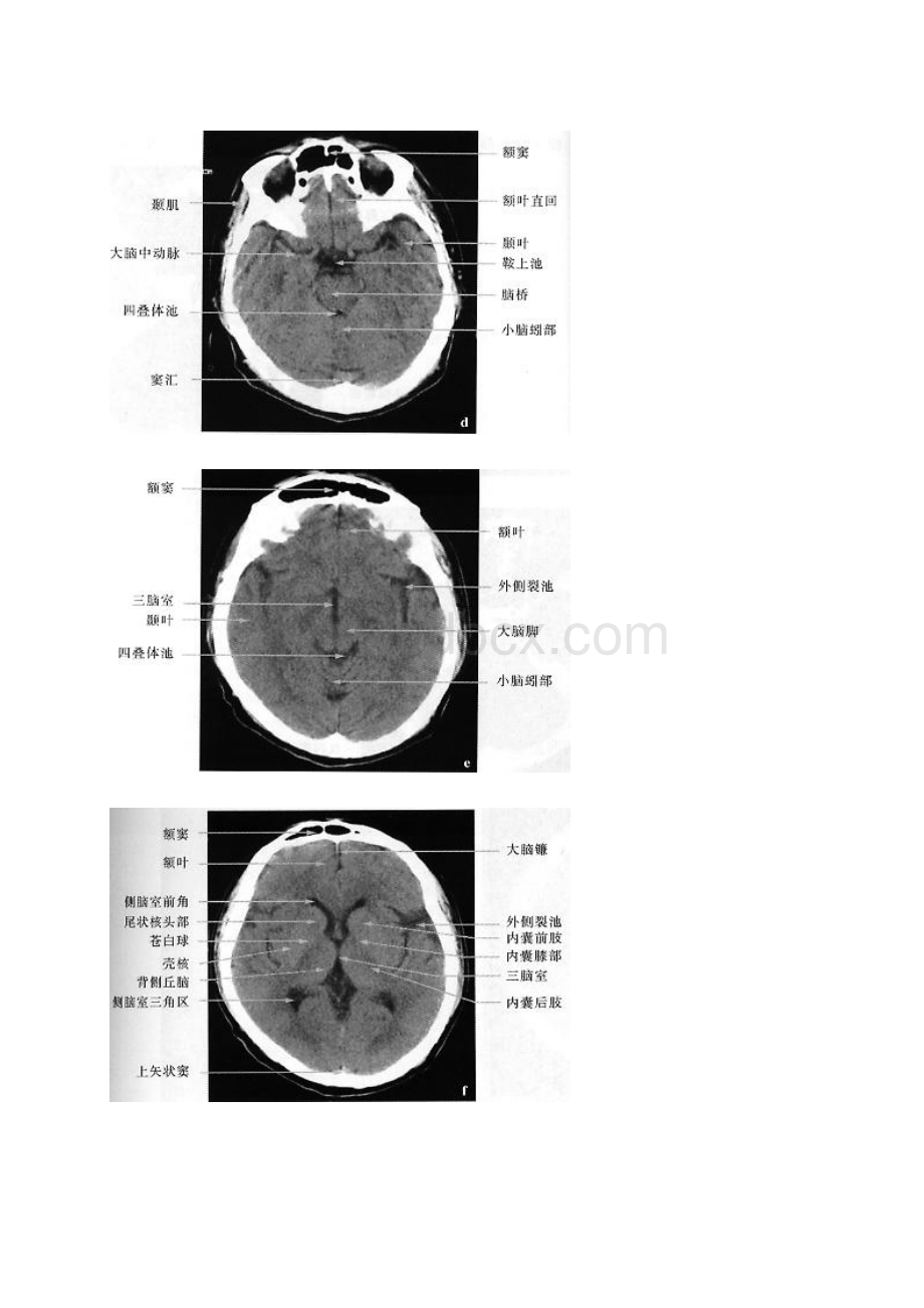 正常头颅CT.docx_第3页