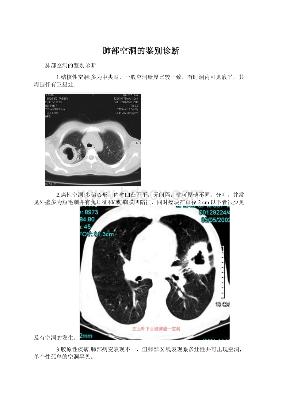 肺部空洞的鉴别诊断Word格式.docx_第1页