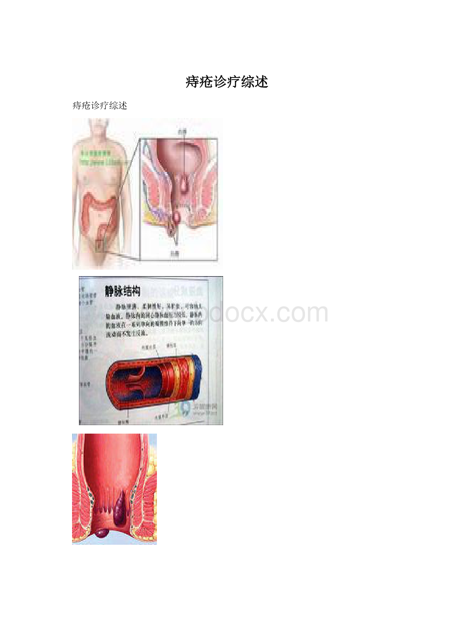 痔疮诊疗综述.docx_第1页