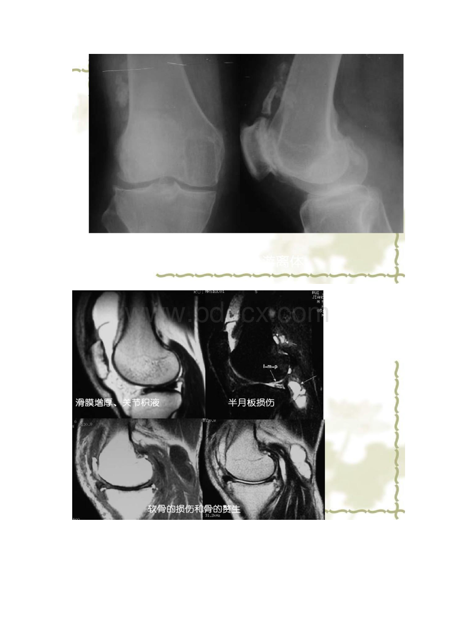 膝关节骨性关节炎2讲解.docx_第2页