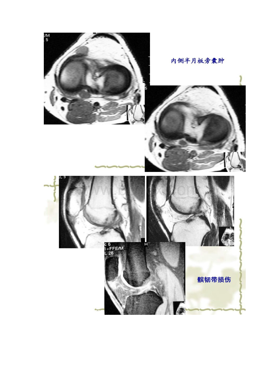 膝关节骨性关节炎2讲解.docx_第3页