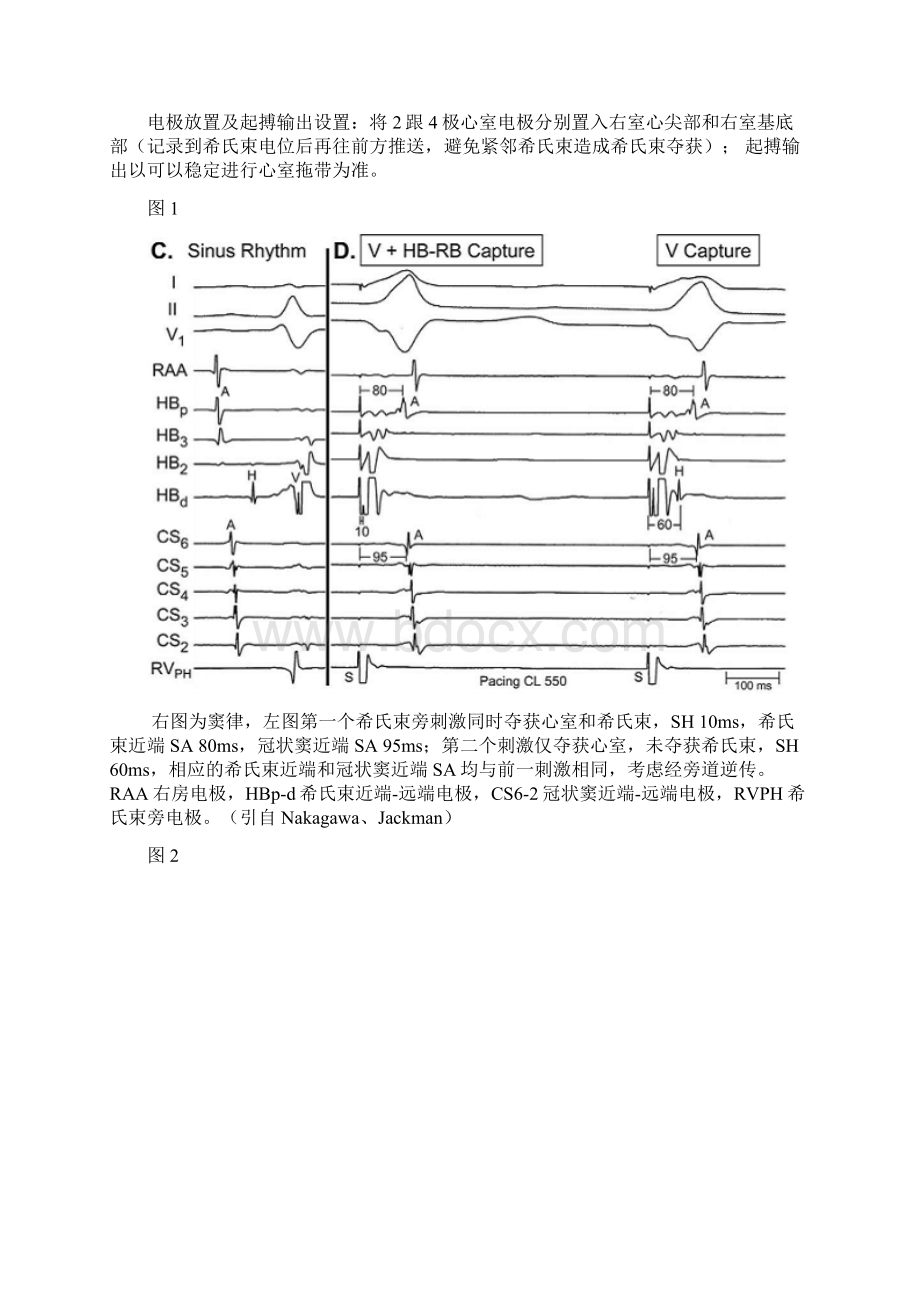 室上性心动过速鉴别诊断的常用心内电生理程序刺激方法概览.docx_第3页