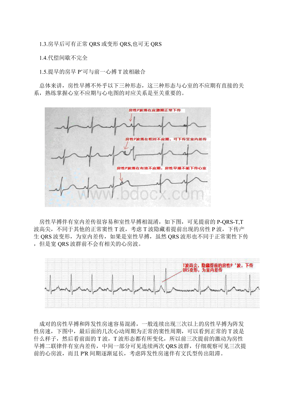 早搏的诊断和鉴别诊断Word文档下载推荐.docx_第3页