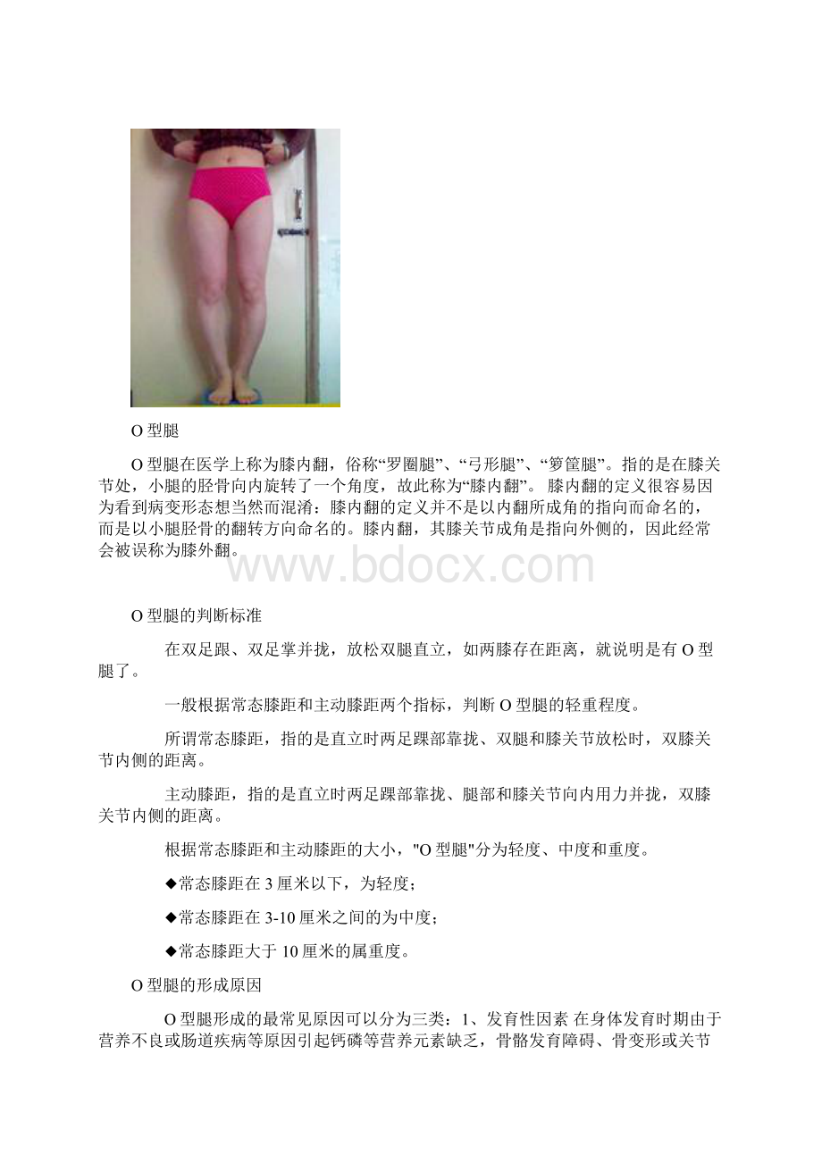 O型腿和X型腿的矫正方法.docx_第2页