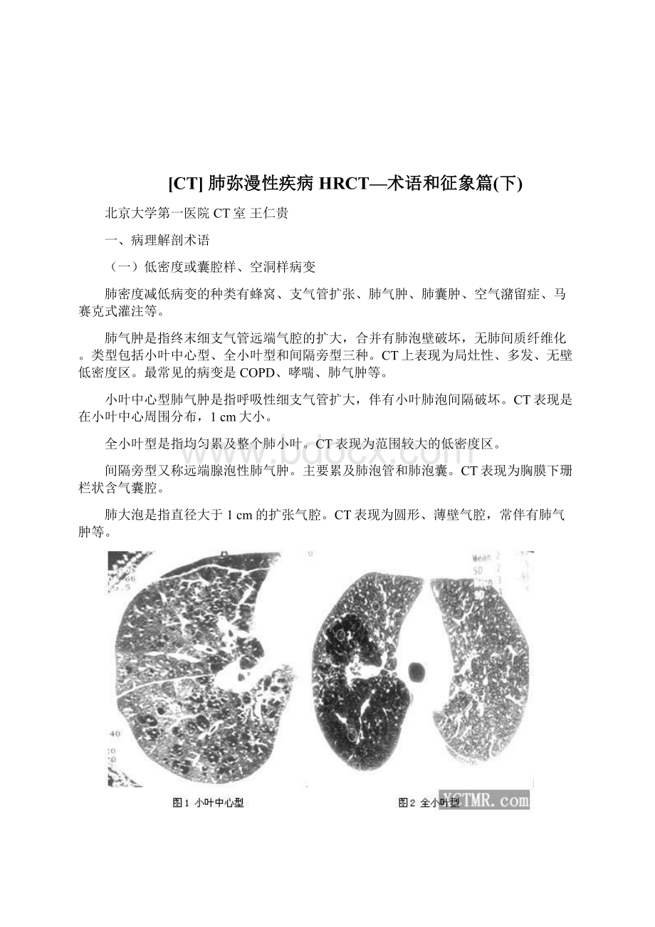 肺部HRCT常见的特殊征象Word下载.docx_第2页