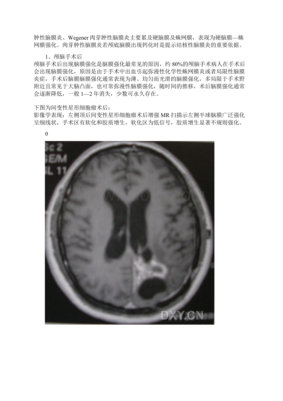 MRI影像脑膜强化疾病.docx_第2页