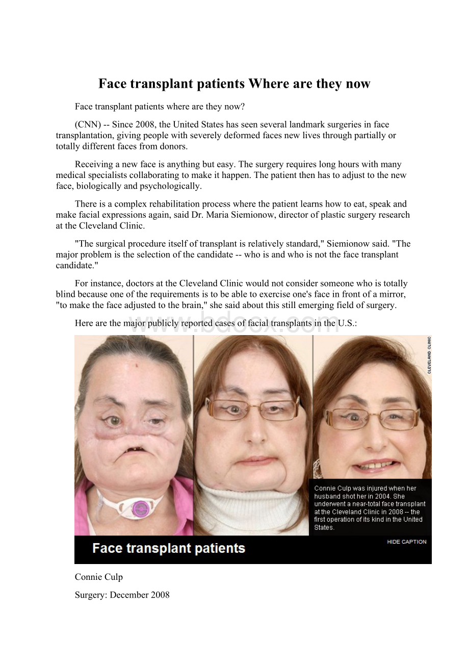 Face transplant patients Where are they now.docx_第1页