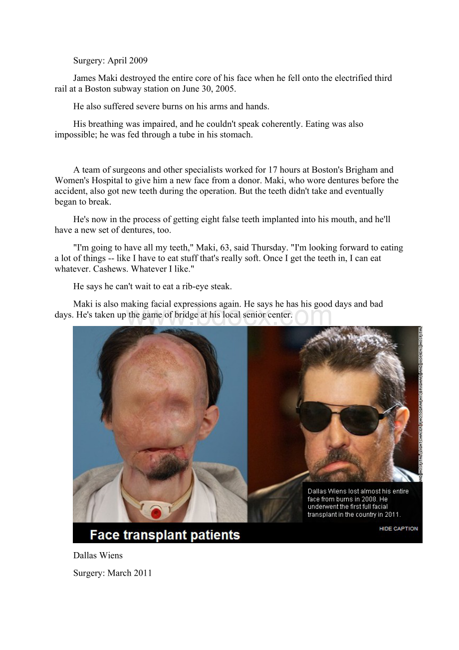 Face transplant patients Where are they now.docx_第3页