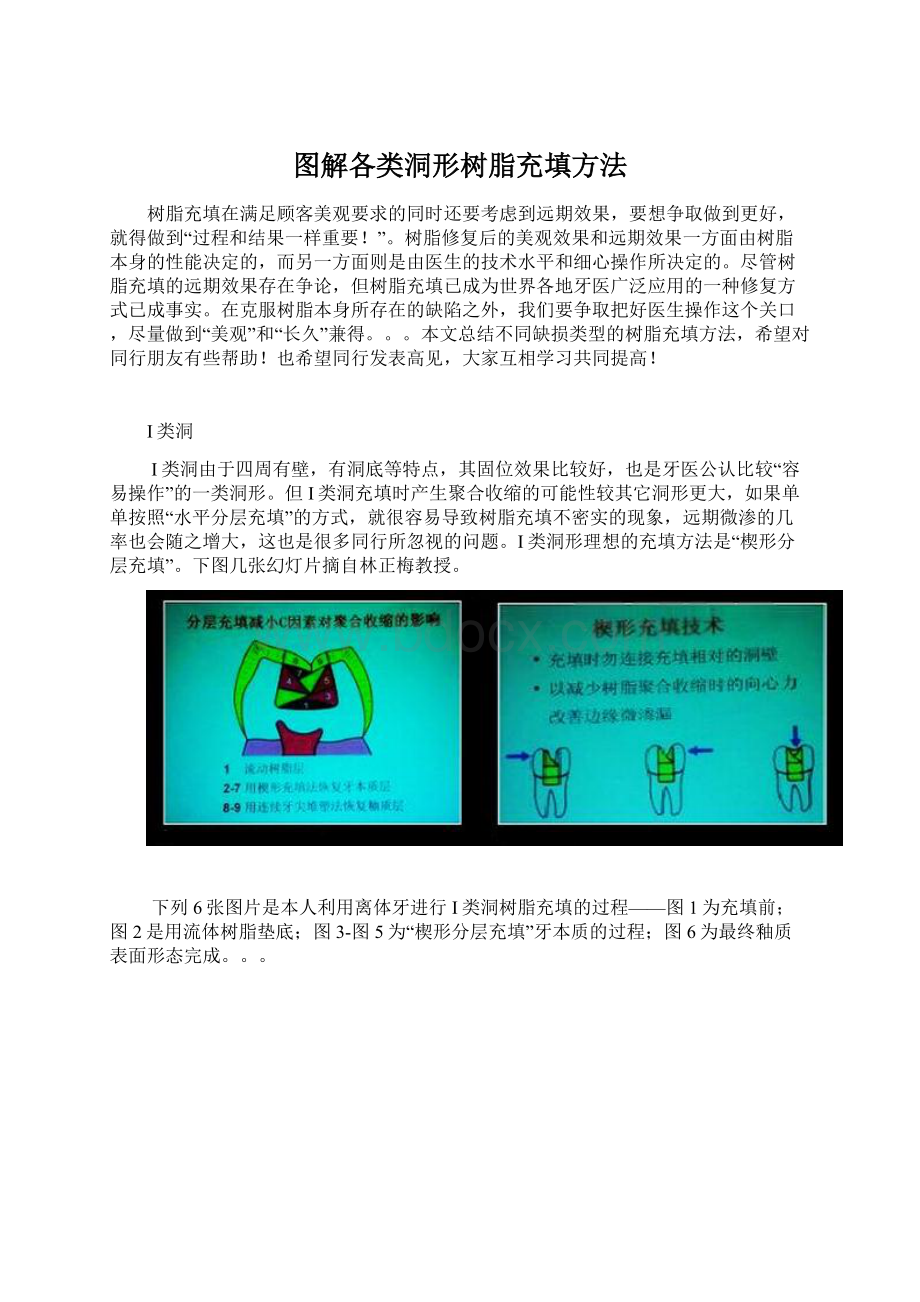 图解各类洞形树脂充填方法.docx