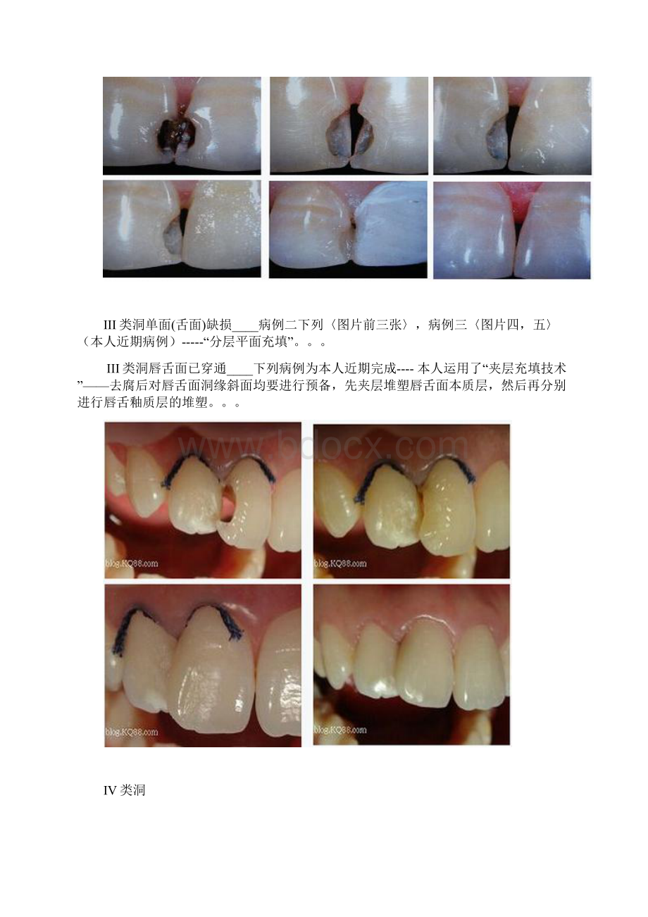 图解各类洞形树脂充填方法.docx_第3页