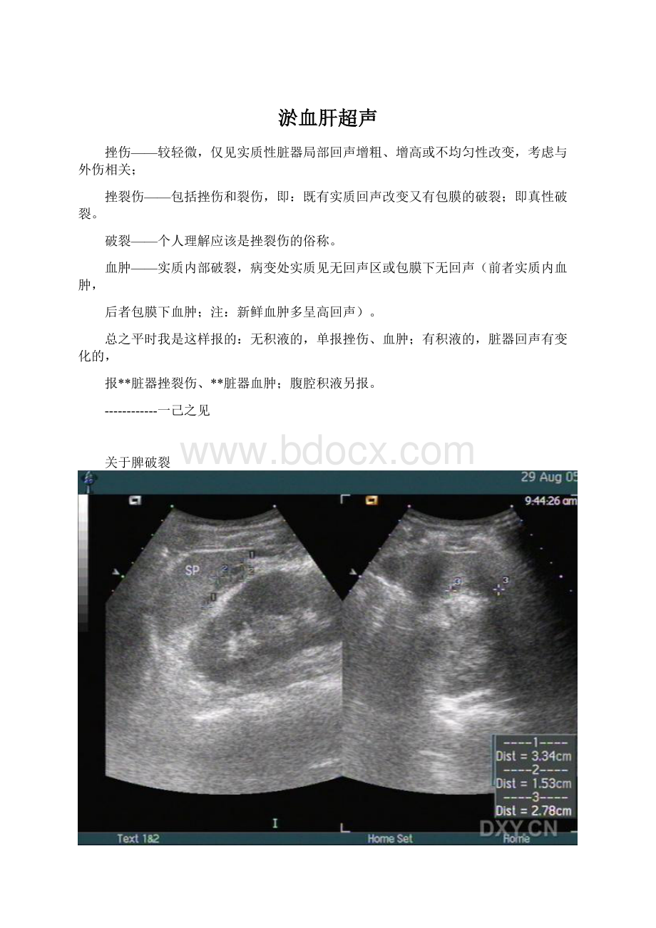 淤血肝超声.docx_第1页