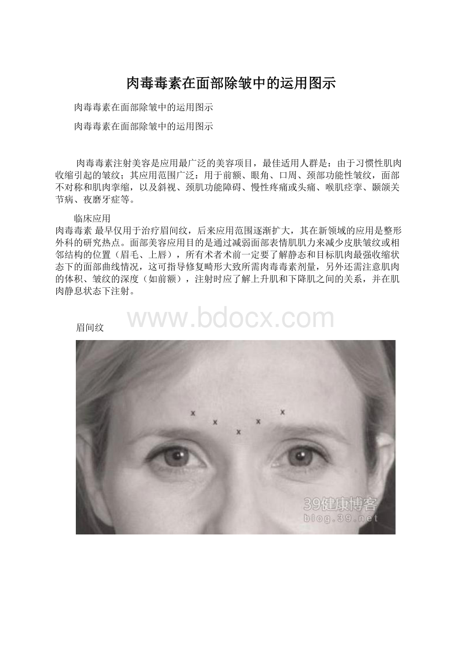 肉毒毒素在面部除皱中的运用图示.docx