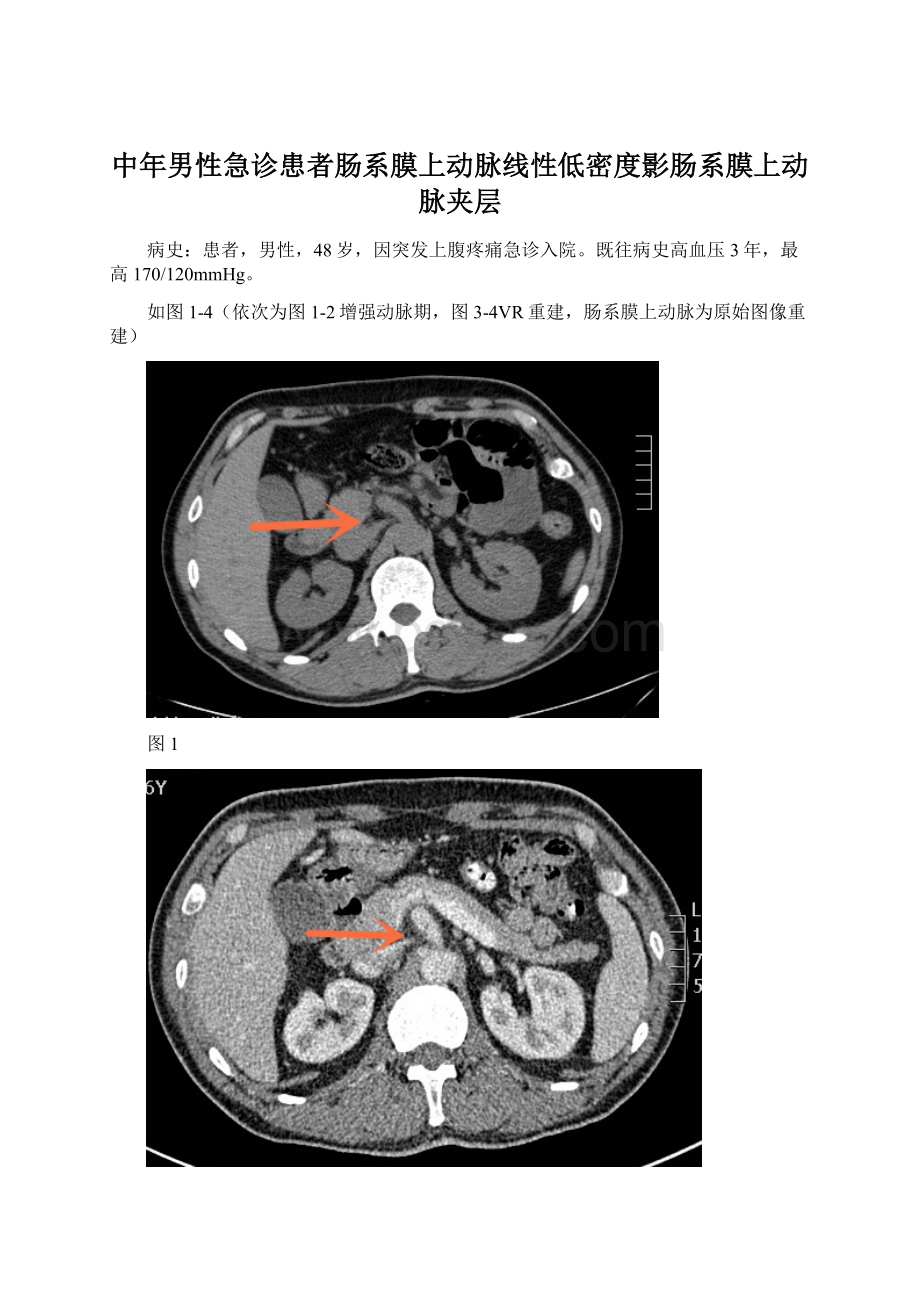 中年男性急诊患者肠系膜上动脉线性低密度影肠系膜上动脉夹层Word文档下载推荐.docx