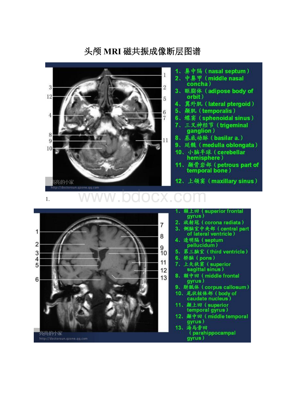 头颅MRI磁共振成像断层图谱Word下载.docx