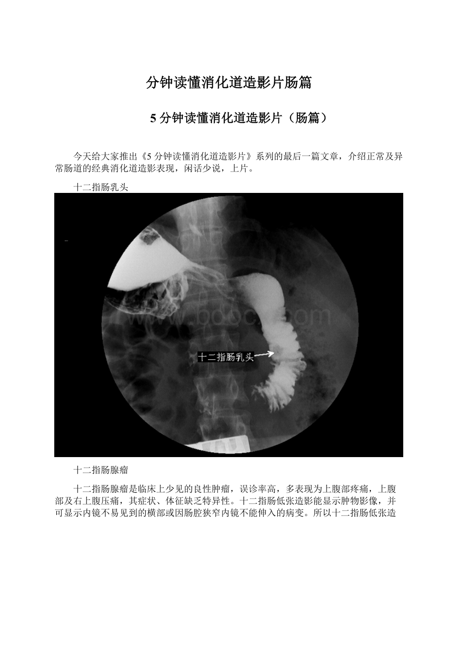 分钟读懂消化道造影片肠篇.docx_第1页