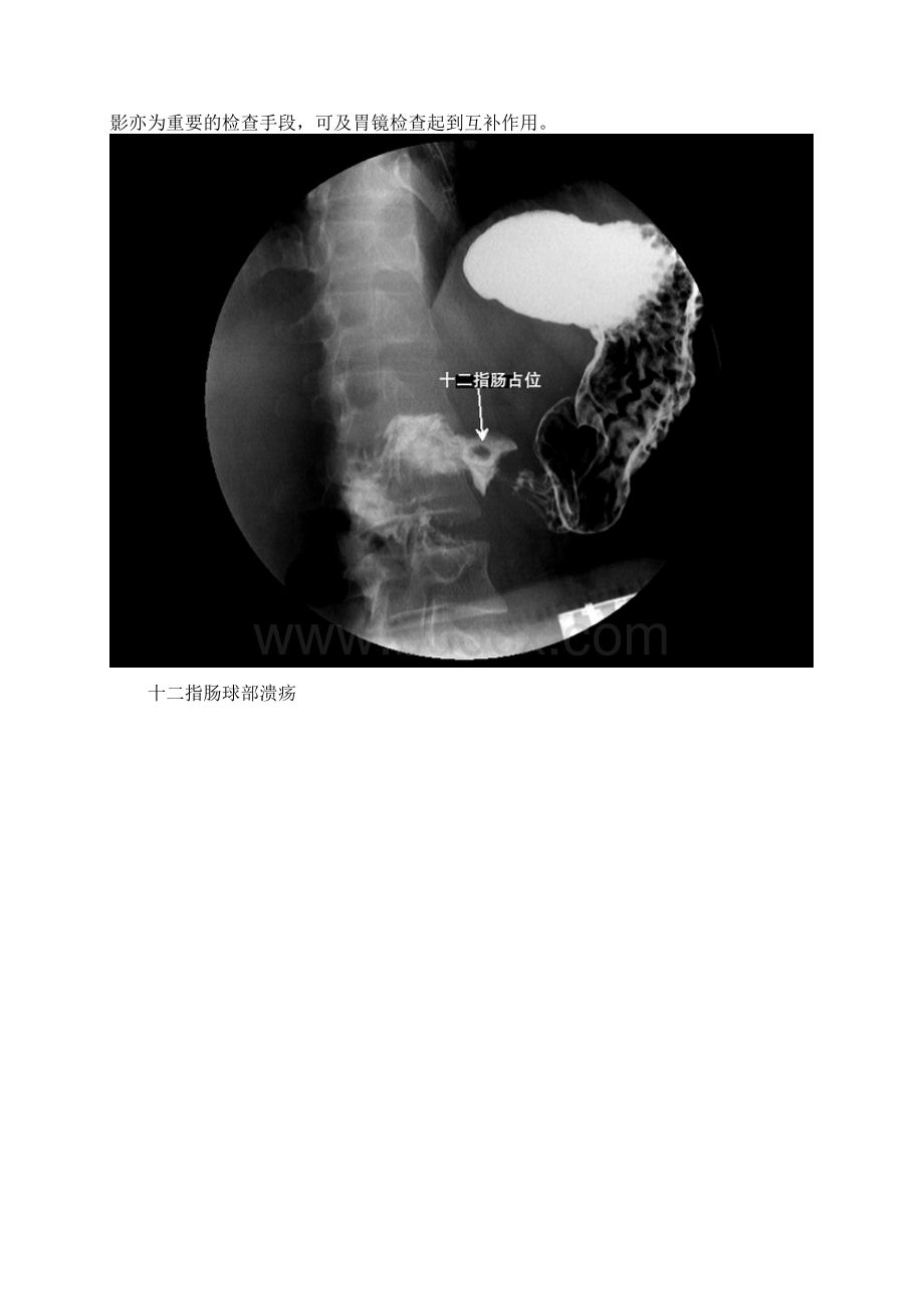 分钟读懂消化道造影片肠篇.docx_第2页