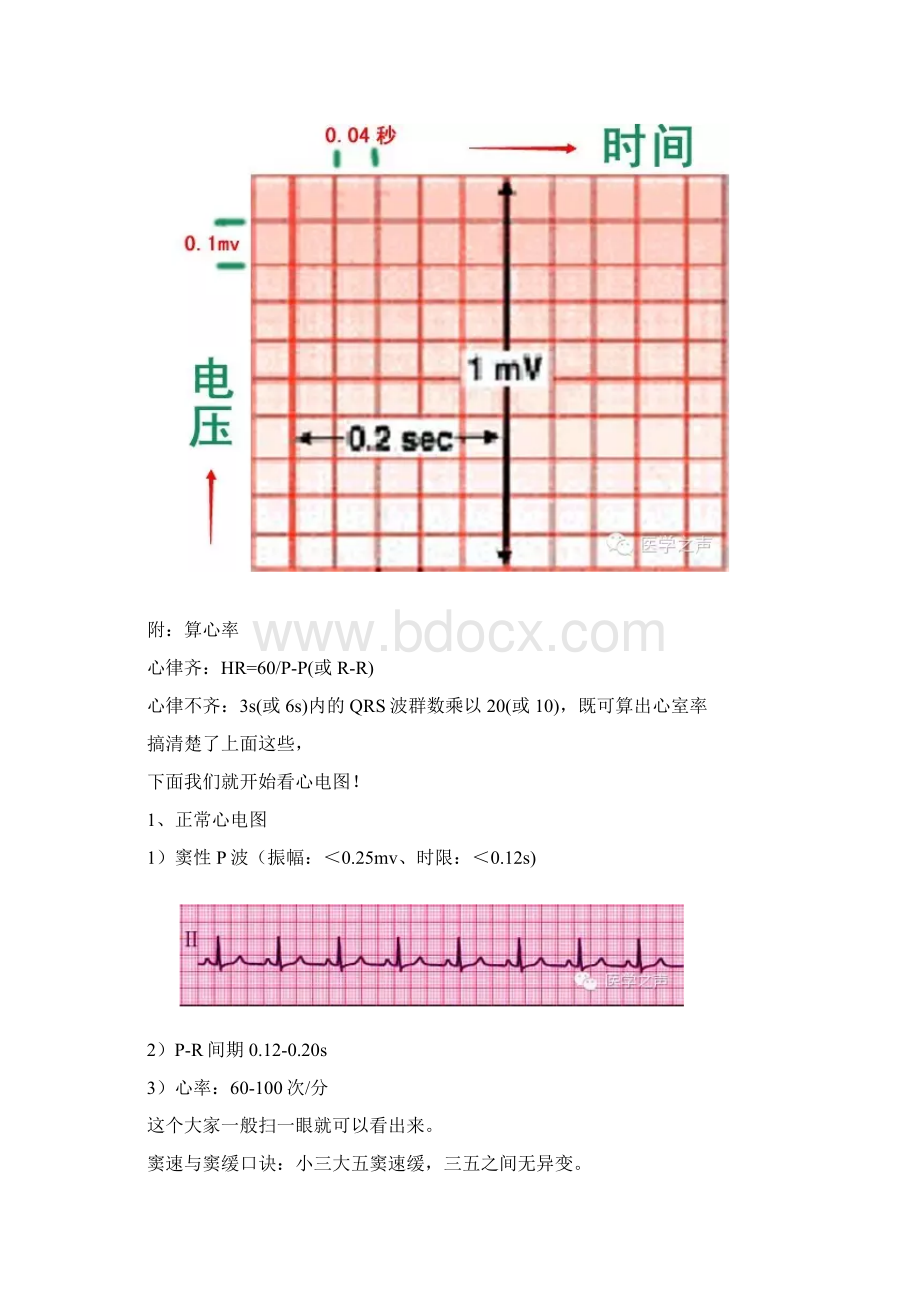 最新临床常见的11种心电图.docx_第3页