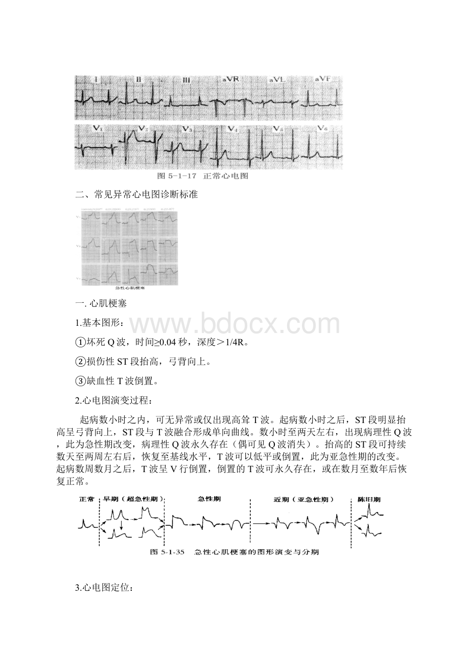 常见心电图特点及波形.docx_第2页